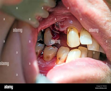 Empty right upper premolar tooth socket one hour after extraction with bleeding, blood clot ...