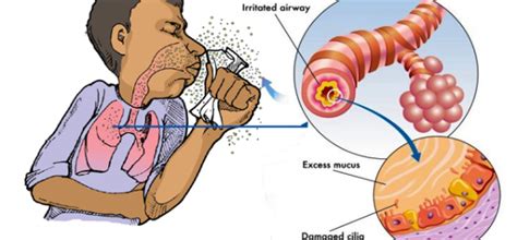 Chronic cough - Symptoms and causes