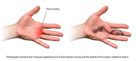 Staying Safe From High Pressure Fluid Injection Injuries During ...