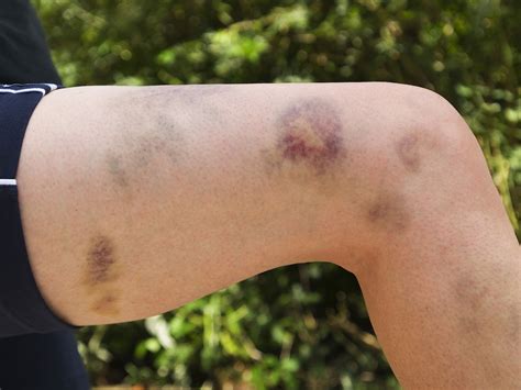 Causes of Easy Bruising: Reasons Why People Bruise Easily | Health Secrets and Tips
