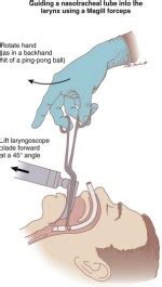 Retrograde Intubation Techniques | Anesthesia Key