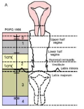 Sacrocolpopexy Anatomy