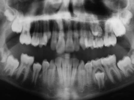 Nonionizing MRI effective for orthodontic imaging