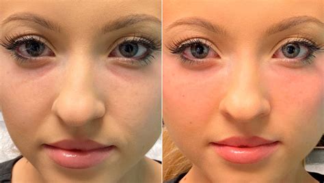 Tear Trough / Under Eye Injections before and after photos - The Naderi ...