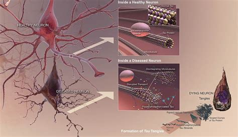 Exercise and Diet Can Reduce Build Up of Protein Linked to Alzheimer's - Neuroscience News