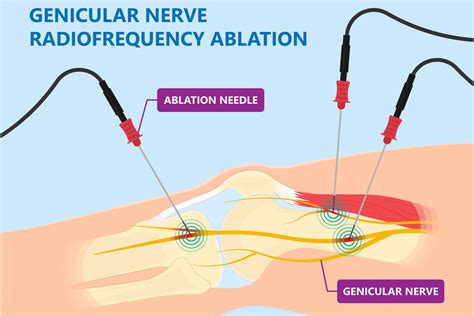 Genicular Nerve Block For Knee Pain | Advanced Surgery Center