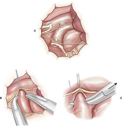 Cardiac Surgery | Veterian Key