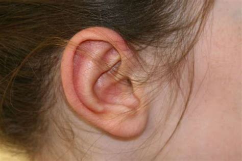 Sticking out Ears & Lobes - no-surgery and surgery options for all ages