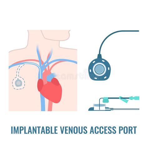 Femoral Central Line Venous Catheter Close Up Stock Vector ...