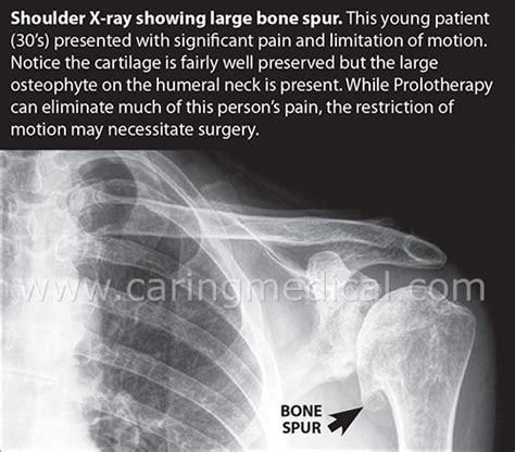 Bone Spur Shoulder Surgery Recovery Exercises - Exercise Poster