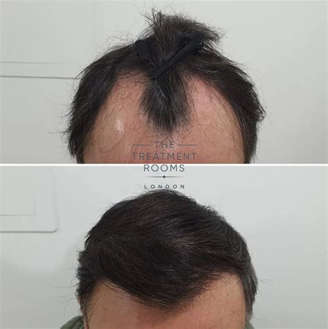 FUE Transplant Before & After | Treatment Rooms London