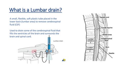 Lumbar Drain The Neurosurgical Atlas - vrogue.co