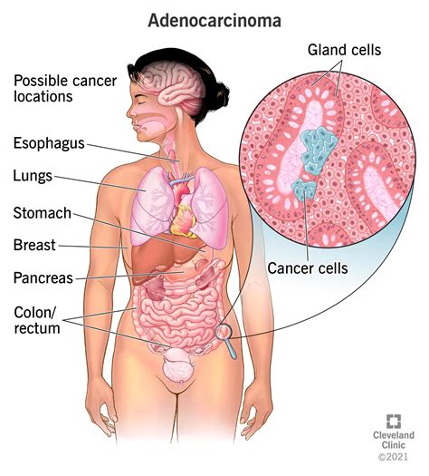 Types Of Cancer: A Comprehensive Guide To Different Forms - Ask The ...