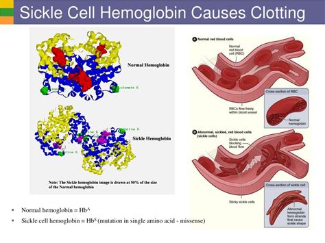 Sickle Cell Hemoglobin Structure