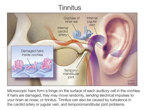 Mayo Clinic Q and A: Tinnitus can interfere with hearing but doesn’t cause hearing loss - Mayo ...