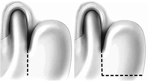 Gastroplastias; a, Collis; b, Wedged-Collis. | Download Scientific Diagram