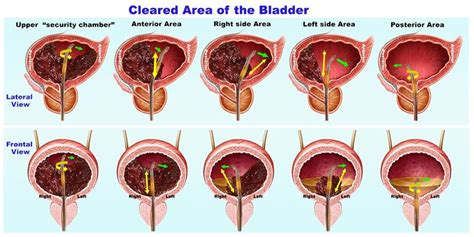 Bladder washout technique step by step. Main washout flow (Green... | Download Scientific Diagram