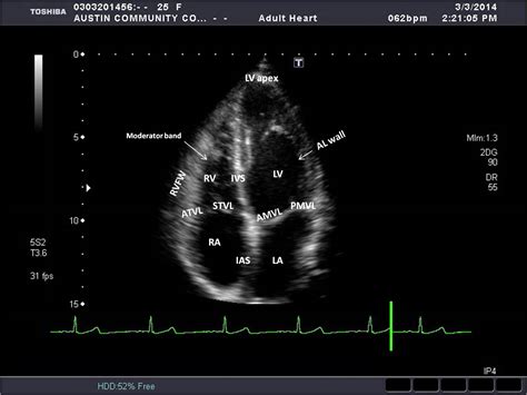 Apical Window | Sonography Resources