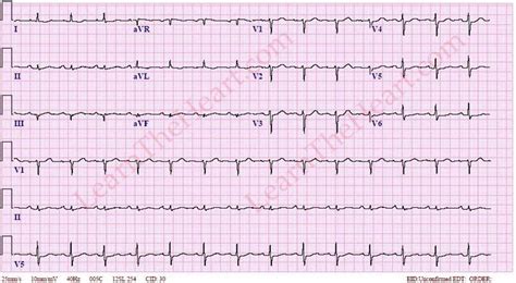 Low Voltage - ECG Example 2 | LearntheHeart.com