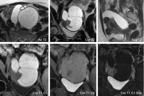 Adnexal Lesions: O-RADS MRI - RAD-ASSIST