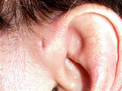 Hole in ear (preauricular pit): What to know