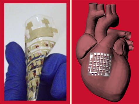 Implantable device can monitor and treat heart disease