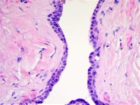 Eyelid Cyst Histology