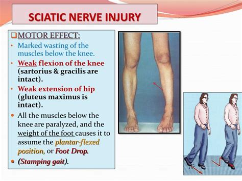 PPT - * SCIATIC NERVE PowerPoint Presentation - ID:2103698