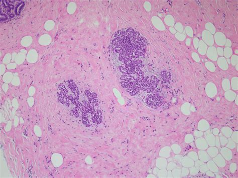 Lobular Lesions (Lobular Neoplasia, Invasive Lobular Carcinoma) | Basicmedical Key