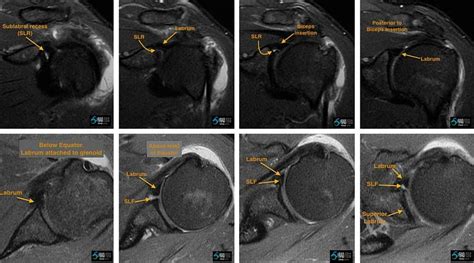 GLENOID LABRUM MRI SIMPLIFIED 4: Sublabral Foramen and Recess | Radedasia