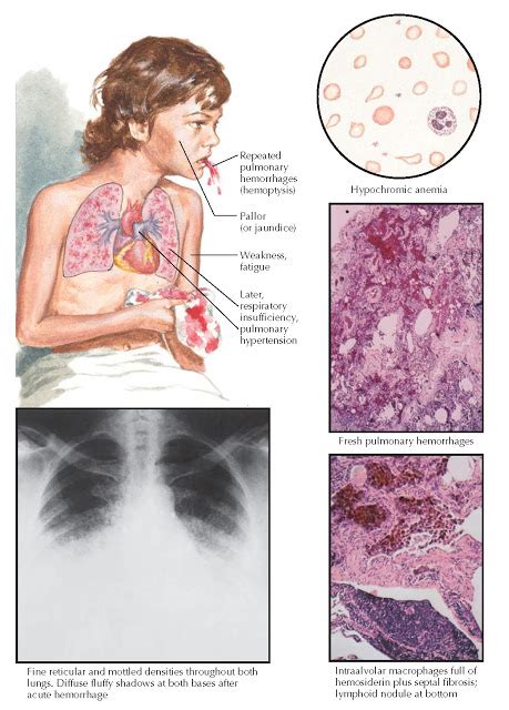 IDIOPATHIC PULMONARY HEMOSIDEROSIS | Medical illustration, Pulmonary ...