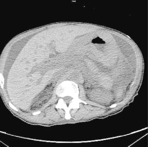 Computed Tomography of abdomen without contrast showing marked... | Download Scientific Diagram