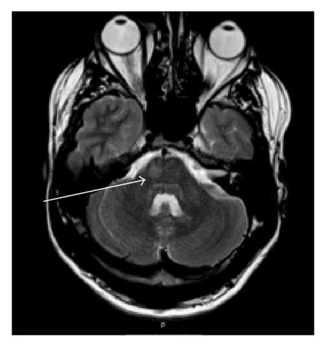 Brain Cavernoma Axial Mri T2 Weighted Image Shows Cen - vrogue.co