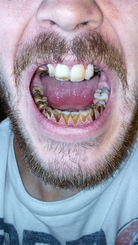 Not sure where to start. Severely messed up teeth. Advice? : Dentistry