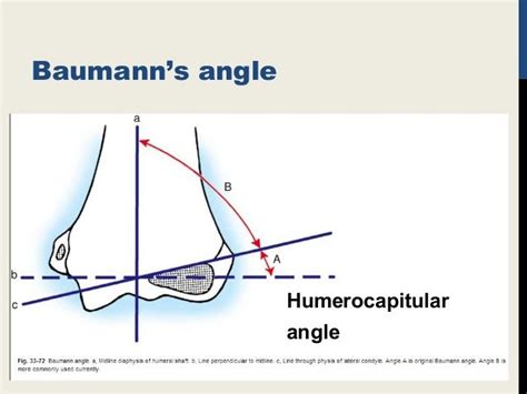 supra condylar fracture humerus