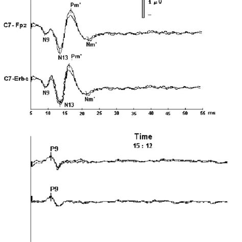 Electroencephalography (EEG) shows the isoelectric line in brain... | Download Scientific Diagram