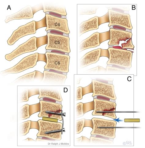 Management of hyper-flexion injury-related teardrop fracture in an adolescent | BMJ Case Reports