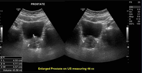 Prostatic artery embolization gains clinical momentum