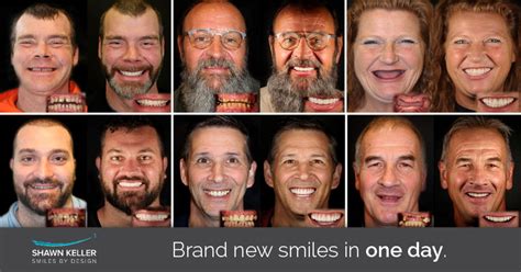 Alternative to Dentures: What is Same Day New Smile™? | Smiles By Design