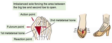 Pain between first and second metatarsal bones | KASAHARA FOOT CARE