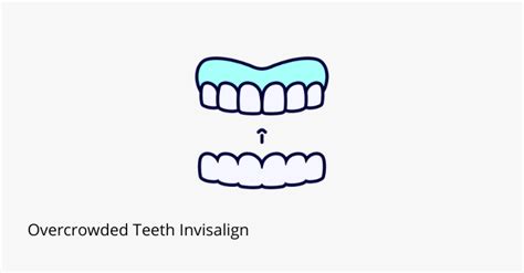 Overcrowded Teeth Invisalign - Share Dental Care