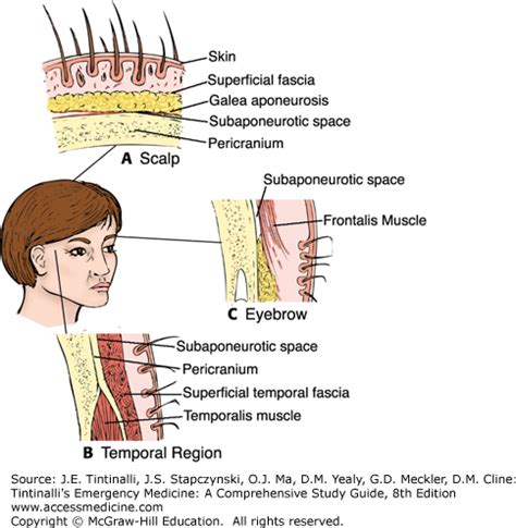 Cranial Laceration