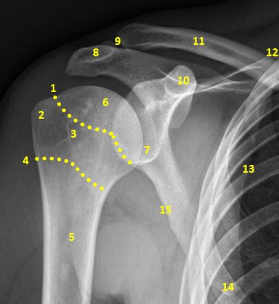 Shoulder radiograph (an approach) | Radiology Reference Article ...