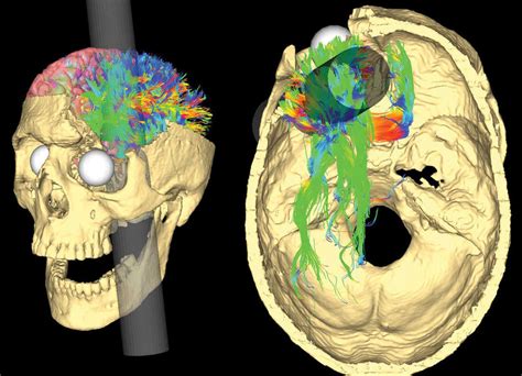 The Curious Case of Phineas Gage's Brain : Shots - Health News : NPR