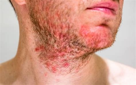 Folliculitis - The Skin Docs