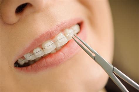 Ceramic Braces vs. Traditional Metal Braces - Hardy Pediatric Dentistry & Orthodontics