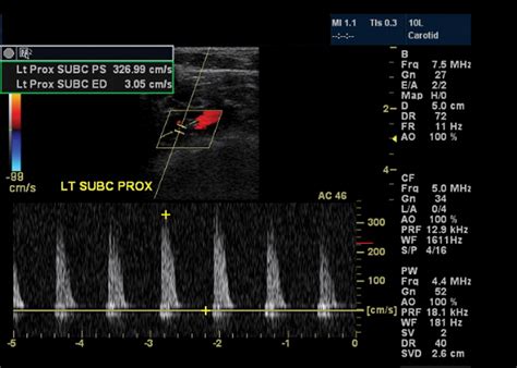 Subclavian Steal Syndrome Ultrasound