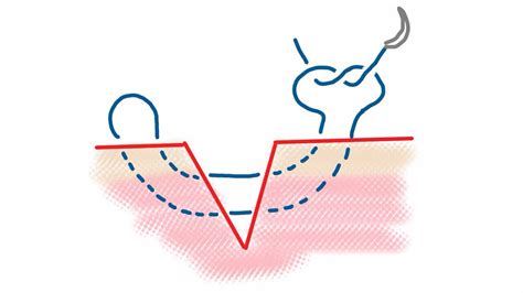 Mattress: Vertical Mattress Suture