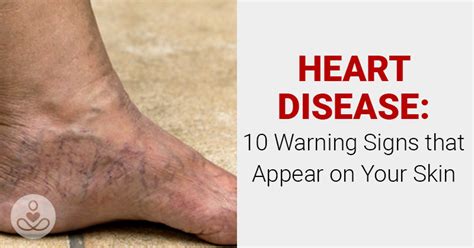 Heart Disease: 10 Warning Signs that Appear On Your Skin : The Hearty Soul