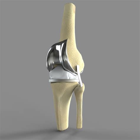 3D knee replacement model - TurboSquid 1520233